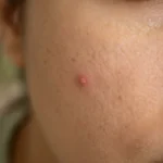 blemish meaning